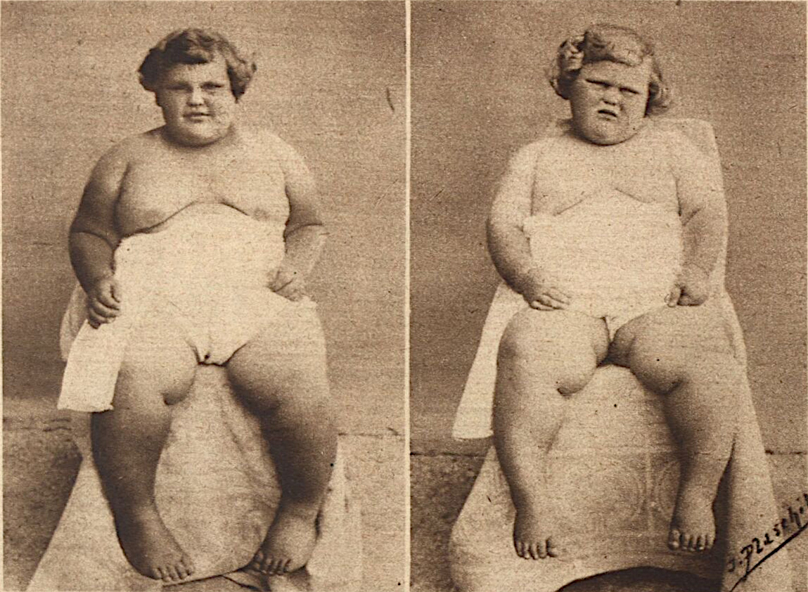 Die Geschwister Nissler 1927: Toni (links) 6 Jahre und 7 Monate alt, 86 kg und Wetti (rechts) 3 Jahre und 10 Monate alt, 48,5 kg